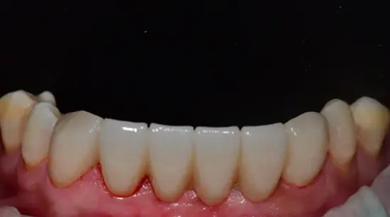 After cosmetic dental treatment showing the patient's restored and enhanced smile.
