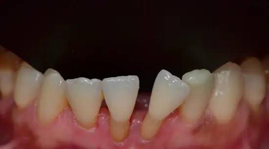 Before cosmetic dental treatment showing the patient's smile prior to treatment.