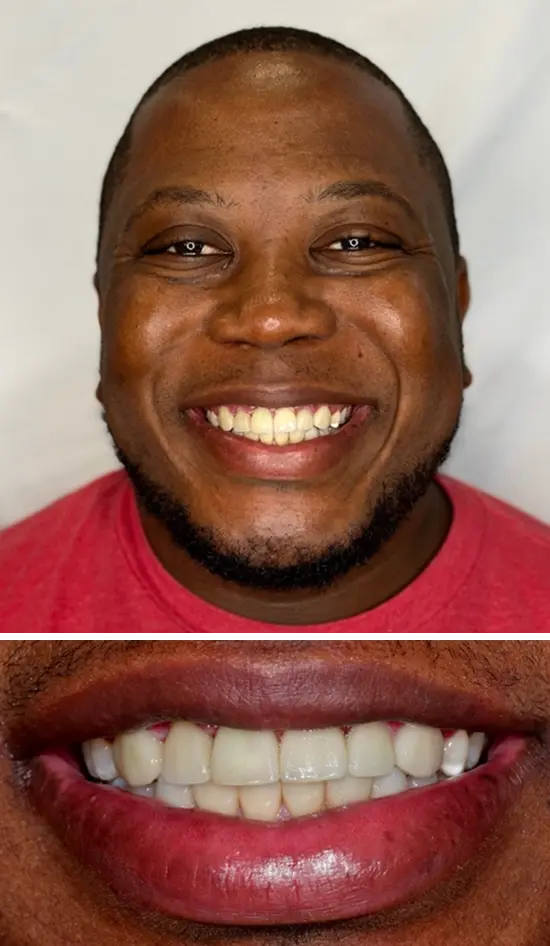 After cosmetic dental treatment showing the patient's restored and enhanced smile.