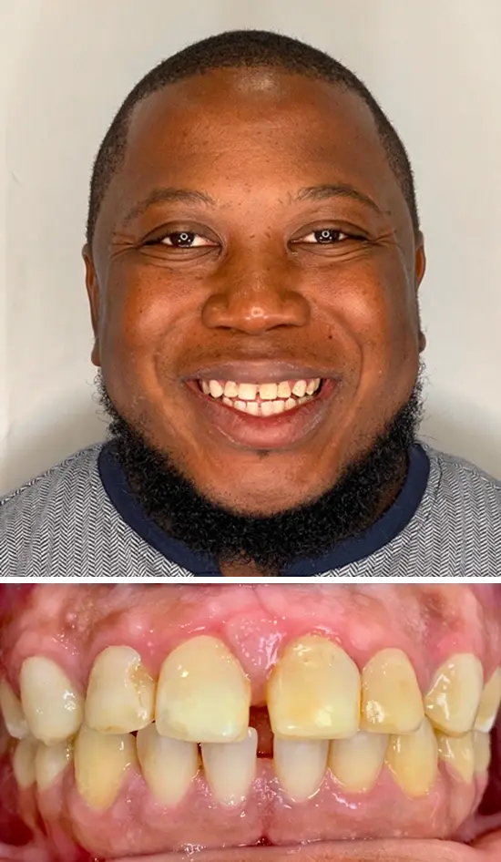 Before cosmetic dental treatment showing the patient's smile prior to treatment.