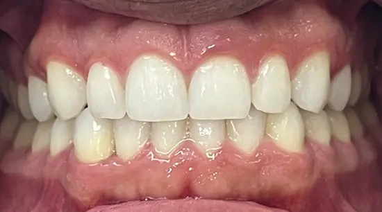 After cosmetic dental treatment showing the patient's restored and enhanced smile.