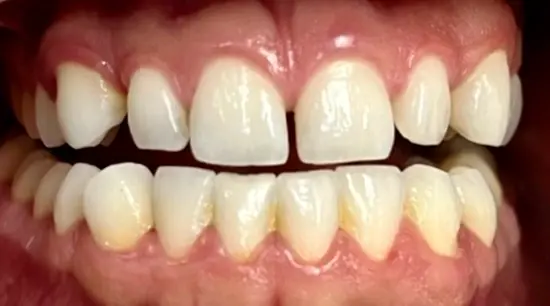 Before cosmetic dental treatment showing the patient's smile prior to treatment.