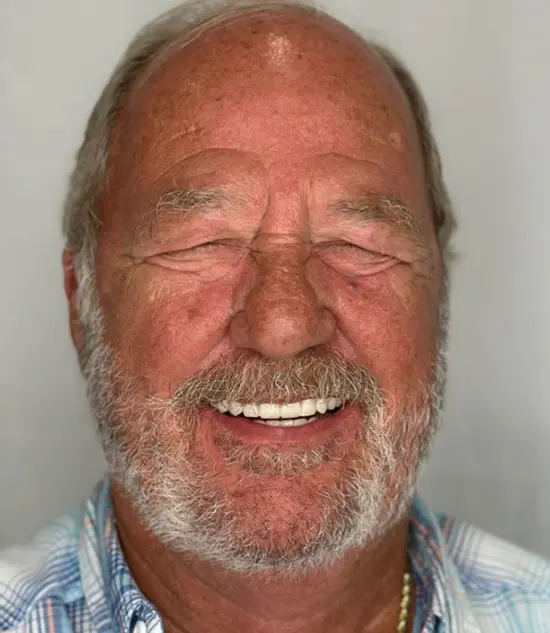 After cosmetic dental treatment showing the patient's restored and enhanced smile.