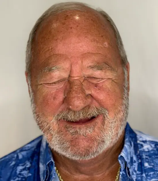 Before cosmetic dental treatment showing the patient's smile prior to treatment.