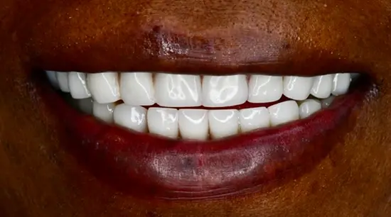 After cosmetic dental treatment showing the patient's restored and enhanced smile.
