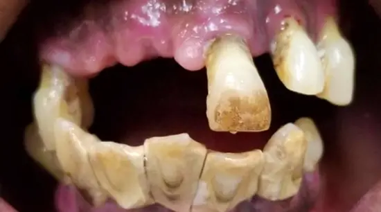 Before cosmetic dental treatment showing the patient's smile prior to treatment.