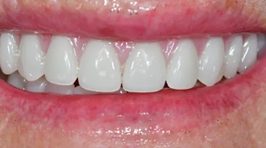 After cosmetic dental treatment showing the patient's restored and enhanced smile.