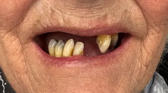 Before cosmetic dental treatment showing the patient's smile prior to treatment.