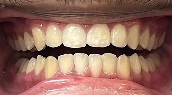 After cosmetic dental treatment showing the patient's restored and enhanced smile.