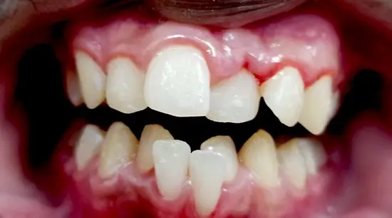 Before cosmetic dental treatment showing the patient's smile prior to treatment.