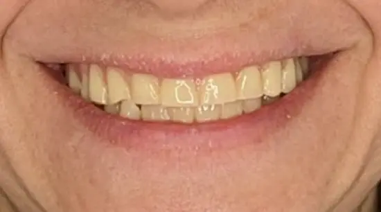 After cosmetic dental treatment showing the patient's restored and enhanced smile.
