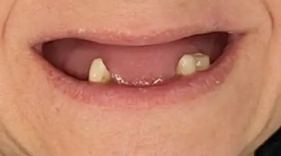 Before cosmetic dental treatment showing the patient's smile prior to treatment.