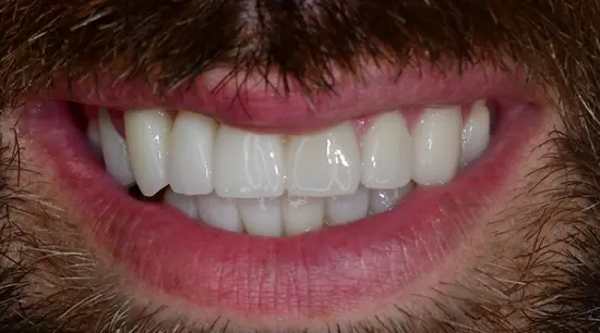 After cosmetic dental treatment showing the patient's restored and enhanced smile.