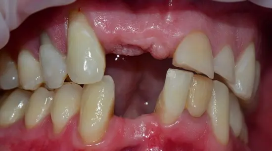 Before cosmetic dental treatment showing the patient's smile prior to treatment.
