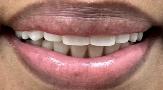After cosmetic dental treatment showing the patient's restored and enhanced smile.