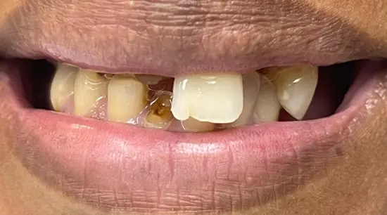 Before cosmetic dental treatment showing the patient's smile prior to treatment.