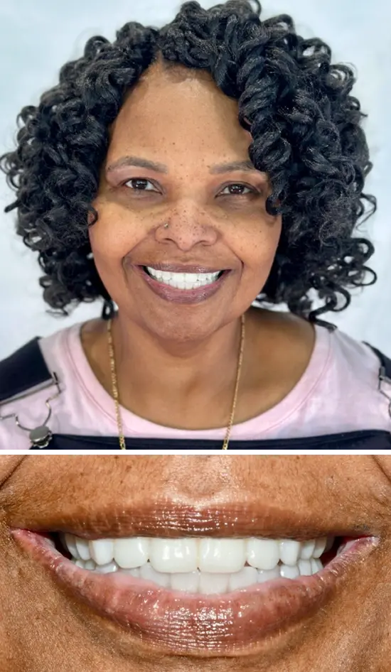 After cosmetic dental treatment showing the patient's restored and enhanced smile.