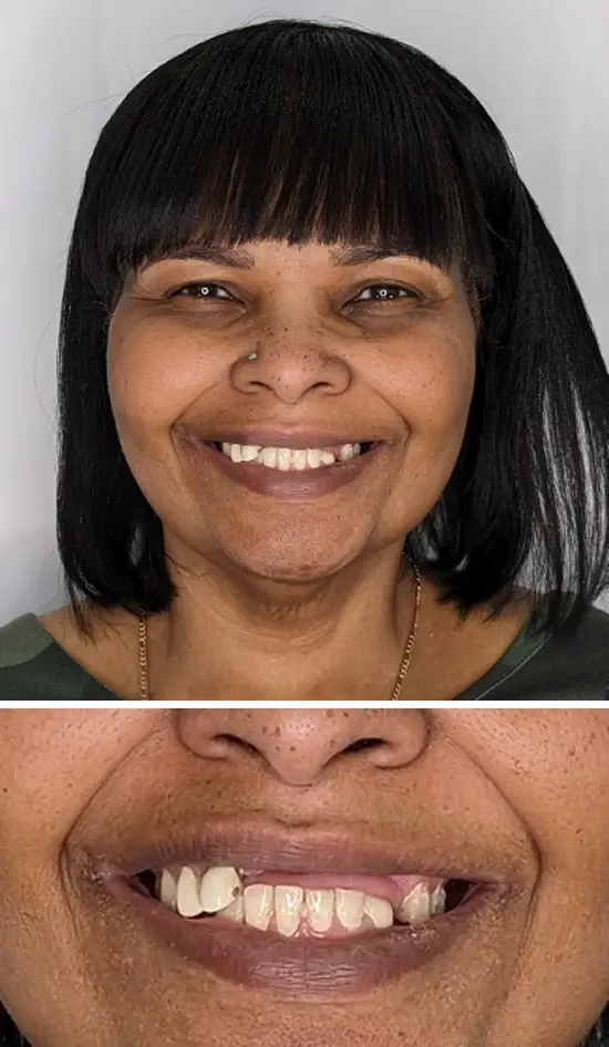 Before cosmetic dental treatment showing the patient's smile prior to treatment.