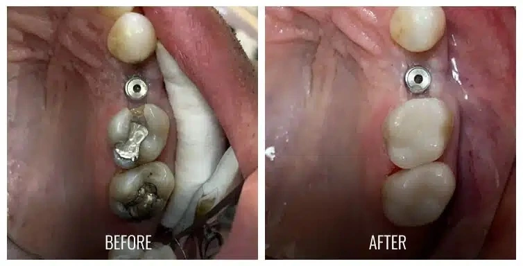 Before and after photos showing dental onlay restorations