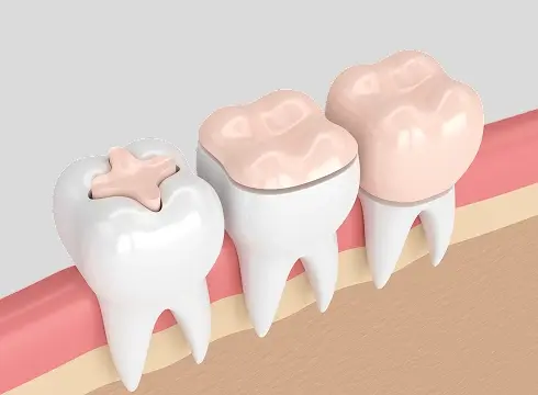 Dental onlays illustration showing progression of tooth restoration with crown and composite onlay treatments in Plantation.