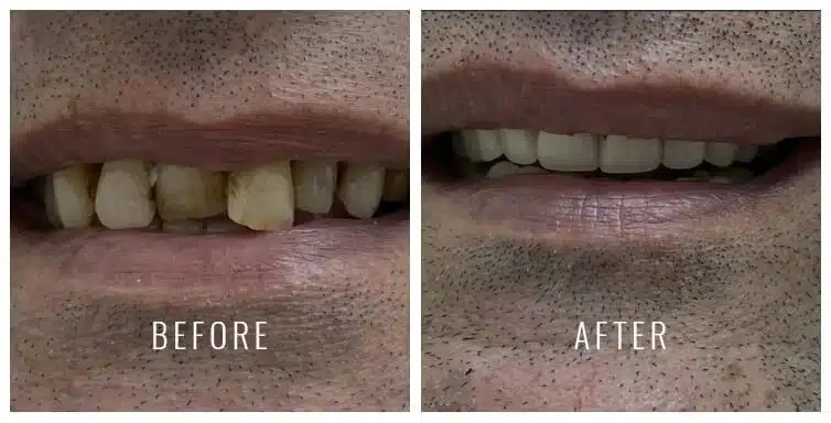 Before and after photos showing dentures restoring a smile