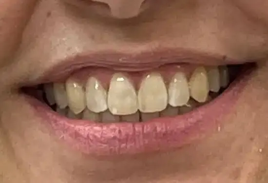 Close-up of a patient's smile showing evenly spaced front teeth after gap closure treatment.