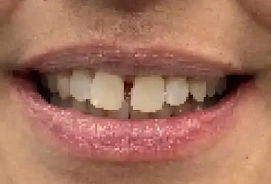 Close-up of patient smile showing gaps between upper front teeth before dental treatment.