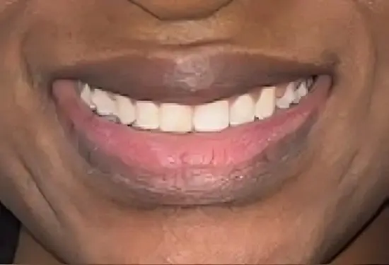 Close-up of patient's smile showing closed gaps between upper front teeth after cosmetic dental treatment.