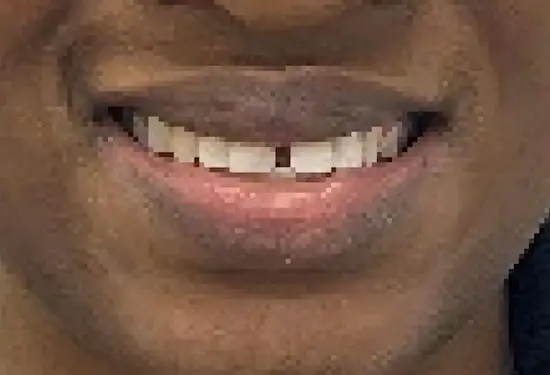 Before photo showing teeth with gaps between front teeth.