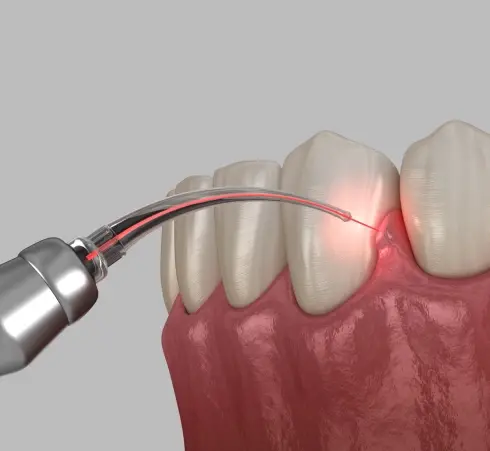 Laser bacterial reduction treatment targeting inflamed gum tissue near teeth in Plantation, FL.