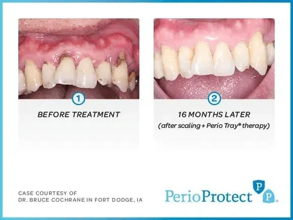 Before and after comparison of gum disease treatment showing improved gum health after scaling and Perio Tray therapy.