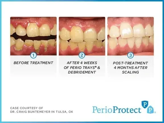 Perioproctect before and after treatment results showing tooth color improvement and gum health restoration over four months.