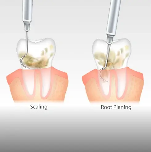 Scaling and root planing dental procedures shown on tooth cross-sections in Plantation, FL.