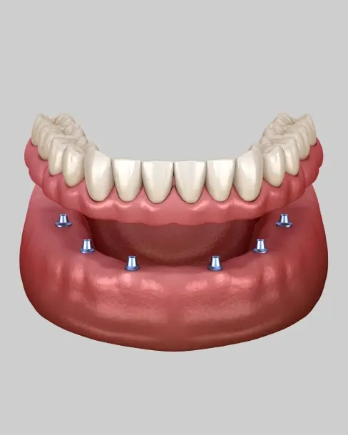 Snap-on dentures supported by dental implants in Plantation, Florida.