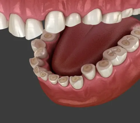 3D dental model showing teeth grinding damage with worn tooth surfaces and jaw clenching effects.